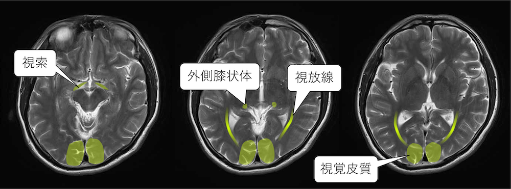 視路と視覚野のMRI画像における正常解剖(視神経→視交叉→視索→外側膝 